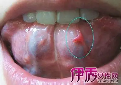【图】舌头下长肉芽图片详解 了解病源及治愈方法