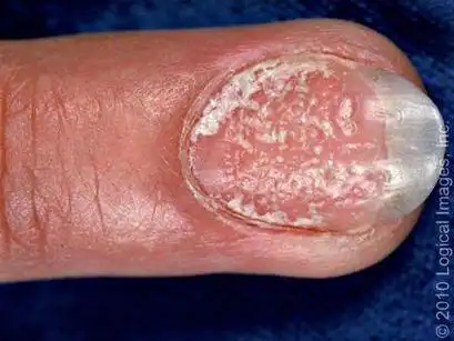 门诊经常有家长询问:宝贝指甲长得不好,是不是缺微量元素?