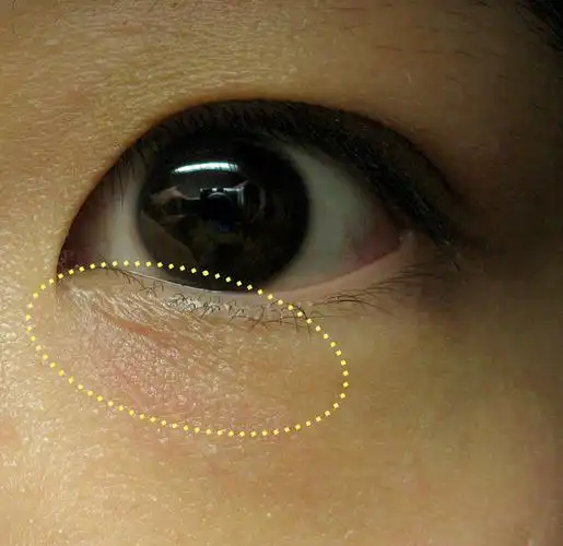 01                 (来源: )            眼部 细纹在医学上为皱纹