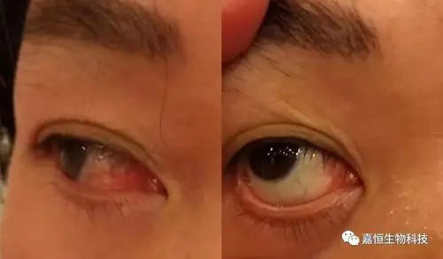 干眼症有多可怕?_眼睛