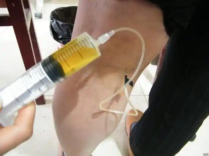 膝关节腔及腘窝积液怎么治疗效果好