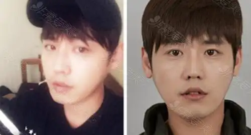 id整形医院轮廓案例曝光,告诉你男生怎样改变更完美!