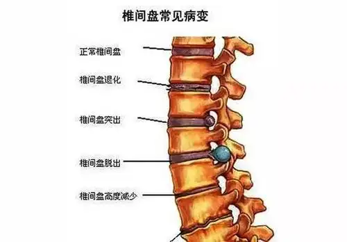 颈椎病背后的伪装面具