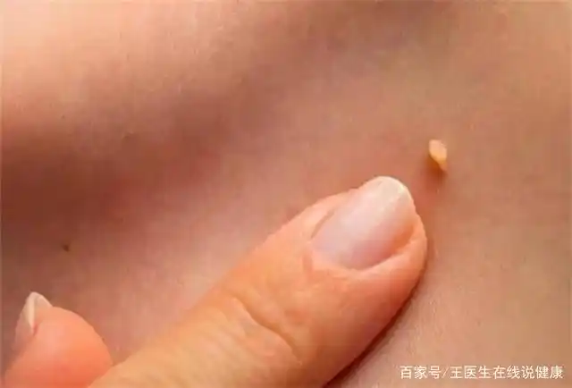脖子和腋下的"小肉粒"是什么?可以用手抠吗?