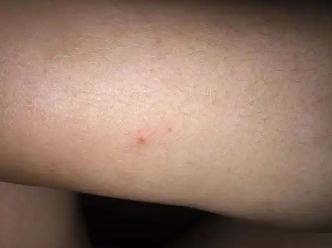 老鼠咬的伤口 老鼠咬的伤口像是老鼠咬的伤口吗?