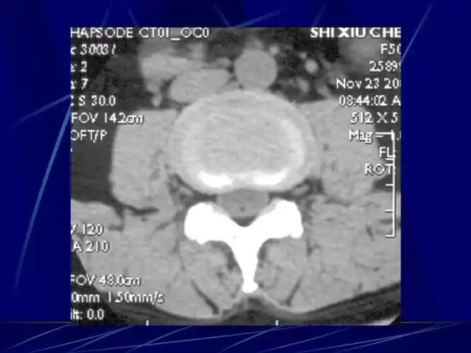 脊柱区断层解剖及ct,mrippt