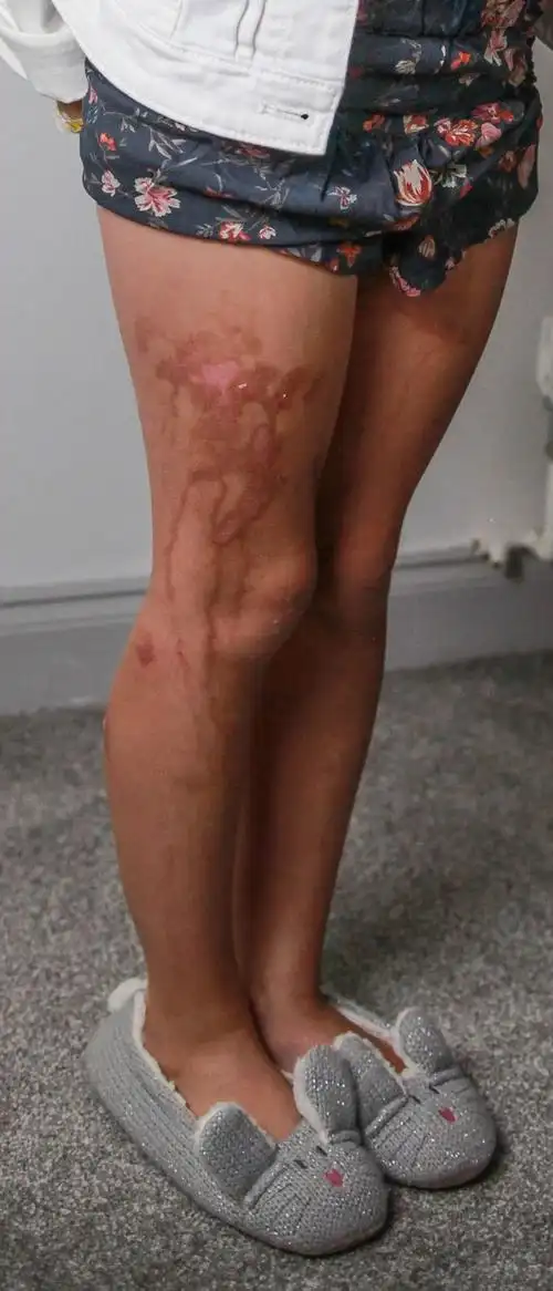 9岁女孩度假涂防晒霜反被严重烧伤