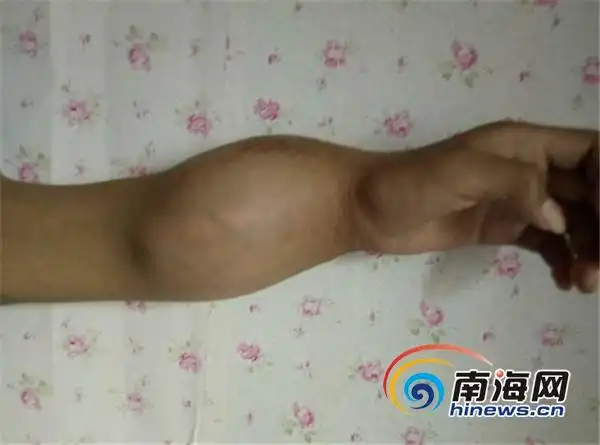 海南定安16岁男孩患骨癌截肢保命 无力承担巨额治疗费