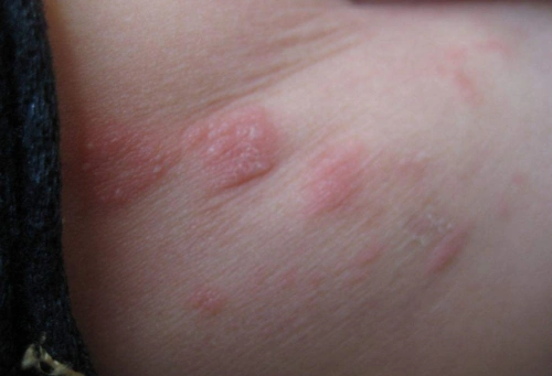 婴儿屁股上起红疙瘩42