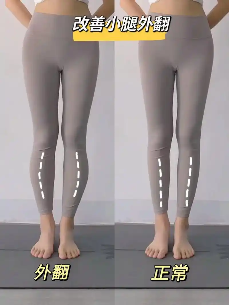 小腿外翻有救啦秒变的纤直腿