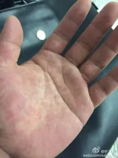 这是血热的症状