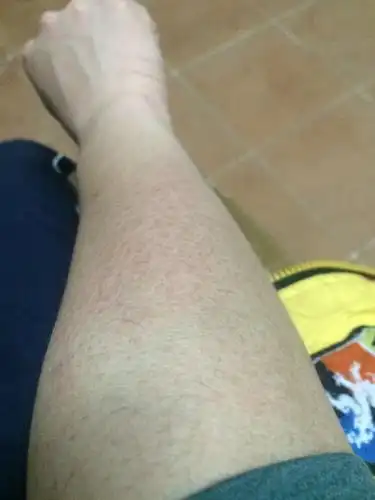 各位,手臂上的这些斑纹是什么回事?能把它消除吗