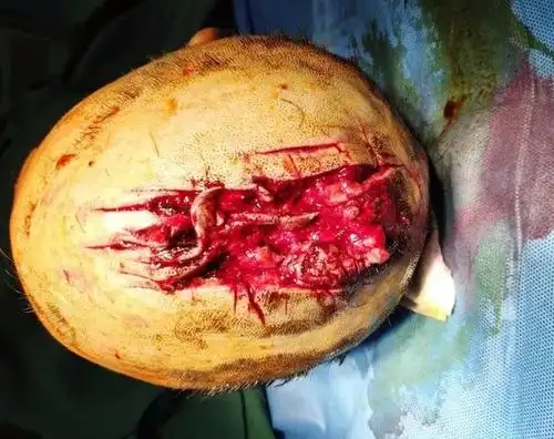 紧急手术治疗一位用菜刀砍伤头部患者