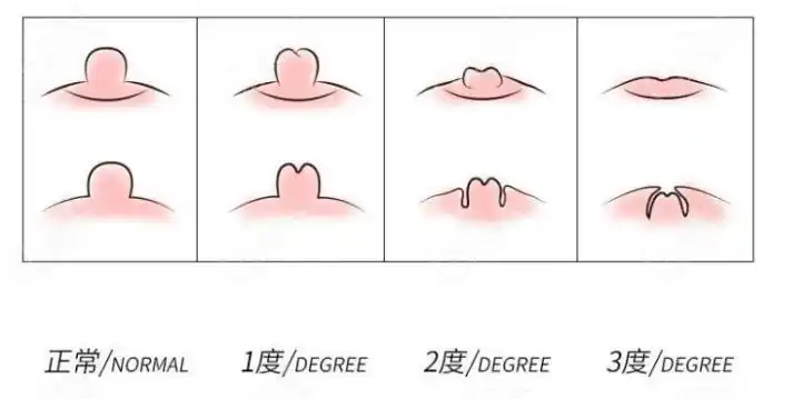 21岁乳头内陷三级怎么矫正过来这种重度内陷能戴矫正器吗