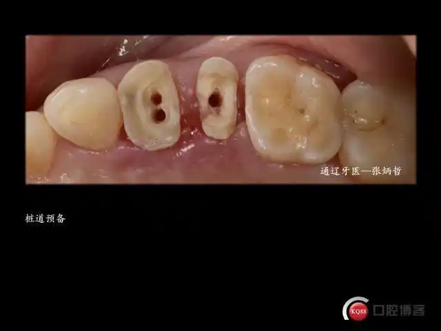 两颗双尖牙的死与生