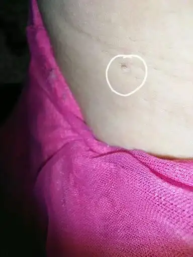 3,皮赘腋下长小肉粒,跟皮肤一样的颜色,还有痒,考虑是皮赘,皮赘一般