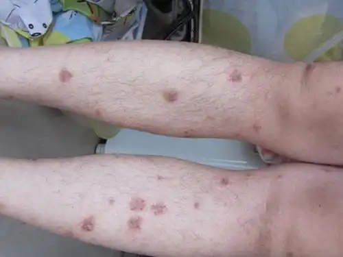 大人湿疹症状图片_有来医生