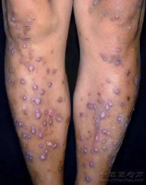 密集恐惧症及非医护人员慎点!史上最全的皮肤病图谱来了(修订版)!