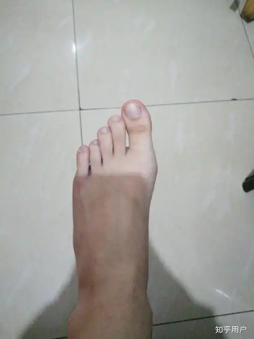 大脚趾特别长,比其他脚趾长很多的人,在现实中存在吗? - 知乎
