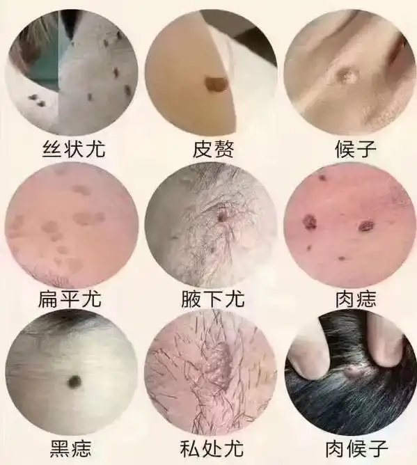 去疣的季节到了!  温馨提示:疣是hpv病毒04引起,传 - 抖音