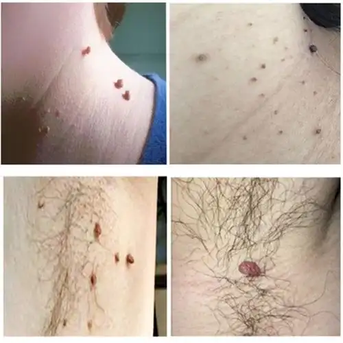 祛治去除丝状尤脖子颈部腋下小肉粒疙瘩猴子肉瘤t面部私处皮赘神