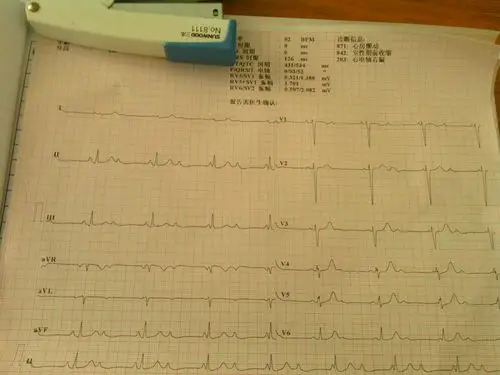一个孕妇的心电图