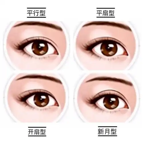 东方人常见的双眼皮形状有平行型,扇型,新月型.