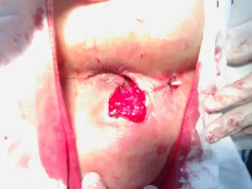 一例复杂性肛瘘的手术