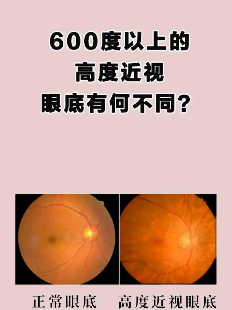 00没错,高度近视患者的镜片厚度比中低度近视的要厚不少,但高度