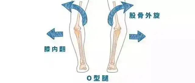 夏天美腿必备,o型腿矫正指南奉上