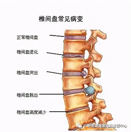 中医支招调理腰椎间盘突出,中药外治法的优势