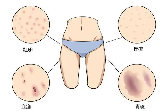 皮防科普有阴虱是什么原因