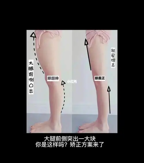 私教精华大腿前侧突出一大块矫正方案