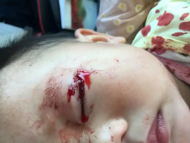 小孩被同学咬伤,家长称幼儿园暗示其肇事小孩的父母有背景__凤凰网