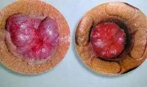 女人产后长痔疮严重图片有图慎入产后痔疮是什么样子