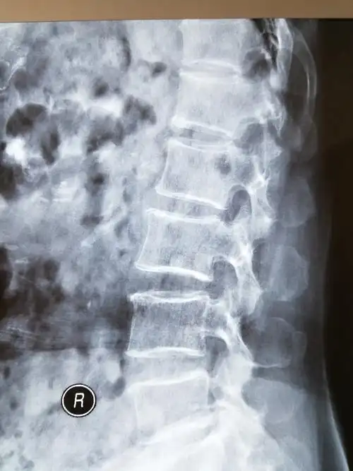中铁一局集团中心医院外二科——腰椎间盘突出症的微创治疗—椎间孔镜
