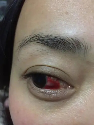 眼白出血,去看医生说是没啥事!有三四天了,非常担心.