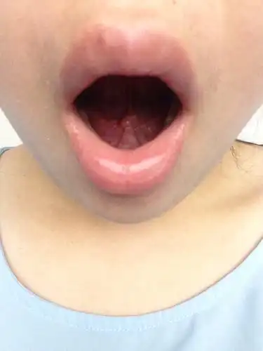 舌头下面多了两个肿块,边上还有一个口腔溃疡,谁知道这是什么引起的吗