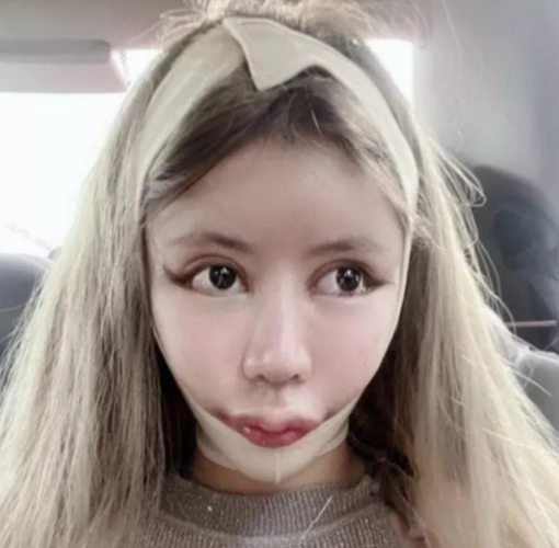 33岁网红抽脂感染身亡,生前照片惨不忍睹:痛到自己打120,两次全身开刀