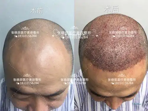 张晓朋医生毛发移植案例