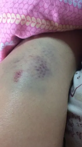 摔倒了,膝盖摔青了由淤血,需要用些什么药