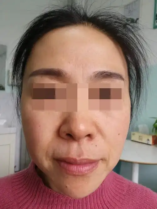 35岁之后为什么面部皮肤松弛严重 面部提升手术能解决那些问题?