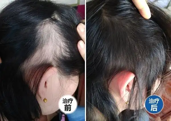 7岁斑秃发友做客北京红旗中医医院远程医生诊室引妈妈团围观 儿童