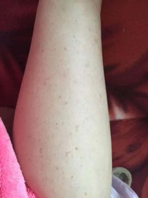 女生小腿肚这是长什么?三年前就长了现在越来越多了不痛跟斑点一样?