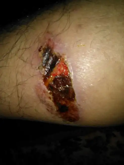 我的小腿被摩托车排气管烫伤了,现在感觉越来越严重了