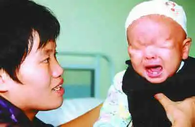 一无眼儿童接受手术 右眼被打开后重新缝合(图)