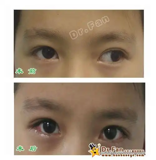间歇性外斜视术前术后照片1