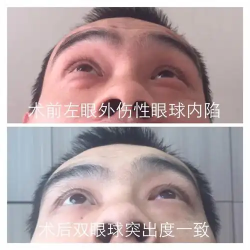 术前左眼外伤性眼球内陷,术后双眼球突出度一致,且皮肤无手术瘢痕.