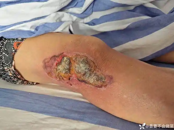 病例分享三度烧伤没钱植皮的换药