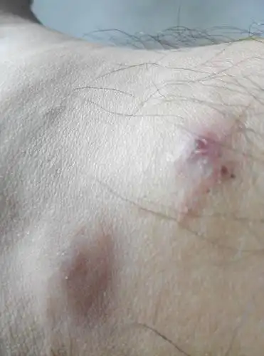 问:腿上总是长这种疙瘩～又疼又痒怎么治啊